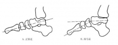 胡霞医生:高弓足的症状是什么?