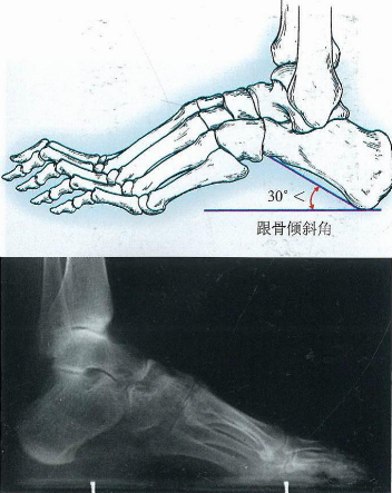 胡霞医生:内翻足怎么治疗恢复比较快?