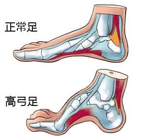 胡霞医生:高弓足无创矫正 不手术不开刀的治疗方