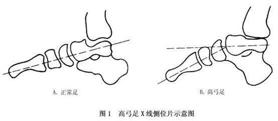 胡霞:小儿高弓足目前有效的治疗方法有哪些